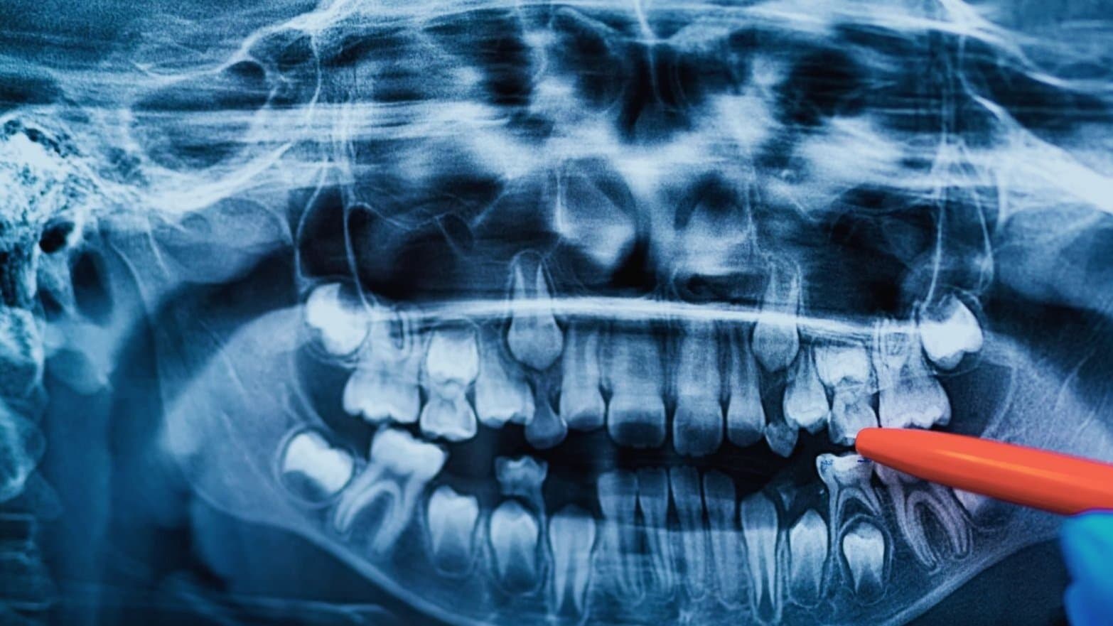 A dental X-ray of the upper and lower jaws, with a pointer indicating an unerupted tooth still held beneath the gumline
